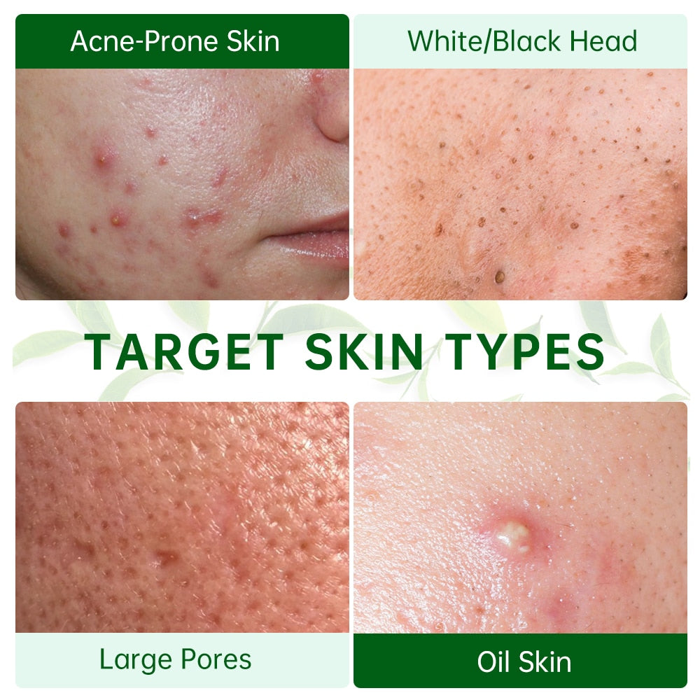 Tea Tree Acne Facial Mask: Pore Cleaning