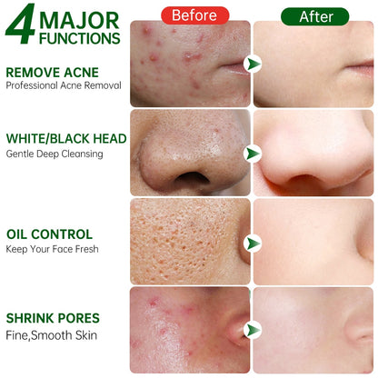 Tea Tree Acne Facial Mask: Pore Cleaning